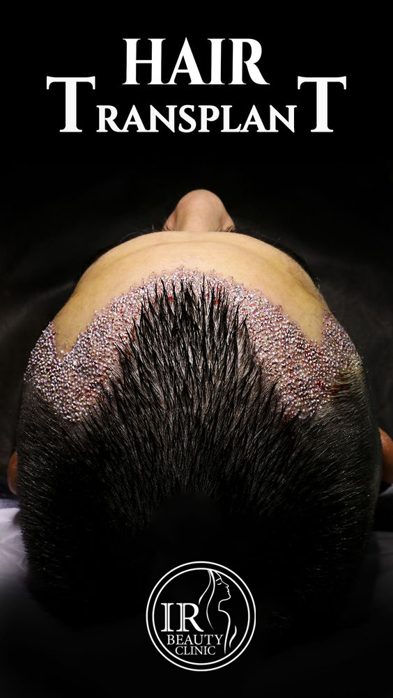 کاشت مو ارزان در تهران